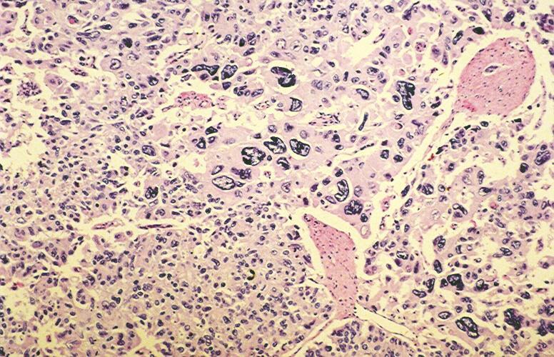 PLEOMORPHIC GIANT CELL ADENOCARCINOMA Rare Admixed with high Gleason score (9 to 10)