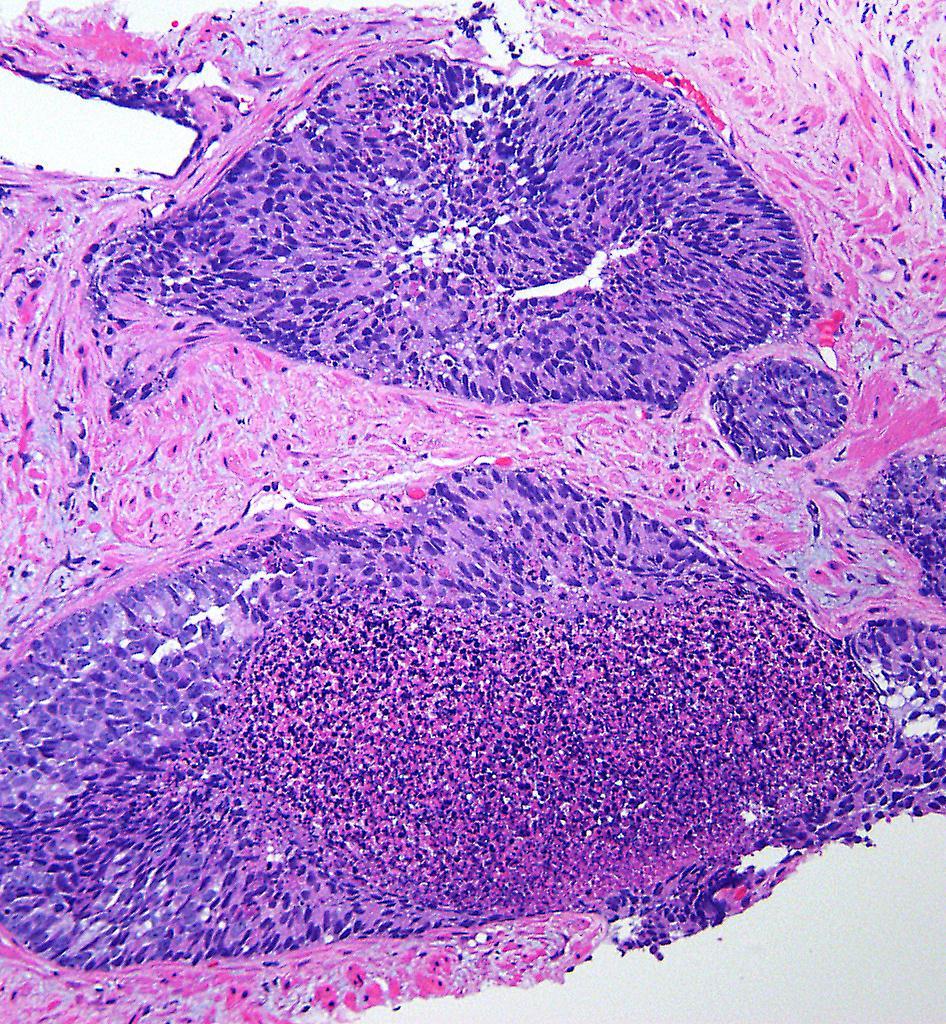 INTRADUCTAL CARCINOMA OF THE PROSTATE An intra-acinar and/or intraductal neoplastic proliferation that has some
