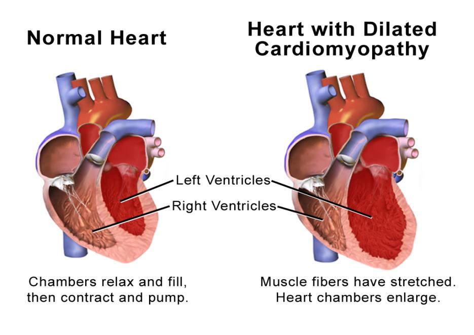 Cardiomyopathy: disease of the