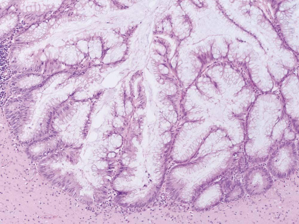 1449 Figure 1 Low-grade appendiceal mucinous tumor with serrated gland architecture ( 200). Four (44%) of the invasive adenocarcinomas were mucinous carcinomas with abundant extracellular mucin.