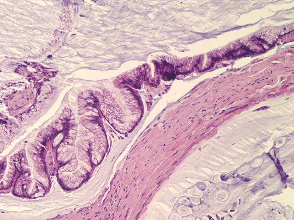 1451 Figure 3 Strips of low-grade mucinous epithelium floating in pools of mucin dissecting through