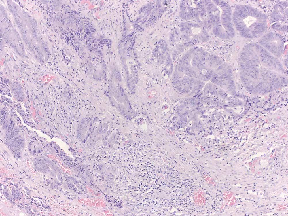 1452 Figure 5 Appendiceal carcinoma, colonic type, in a 26-year-old female. This tumor demonstrated defective mismatch repair protein expression (see Figure 6).