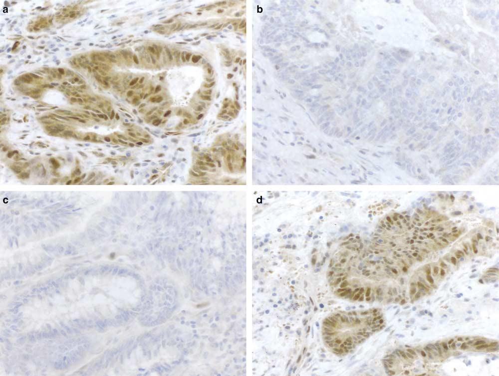 1453 Figure 6 Immunohistochemical stains for mismatch repair proteins of the tumor shown in Figure 5. (a) Intact hmlh1; (b) absent hmsh2; (c) absent hmsh6; (d) intact hpms2 ( 400).