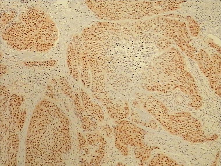 Slika 40. Prikaz imunohistokemijskog bojanja na p53 pločastog karcinoma gradusa II orofarinksa.