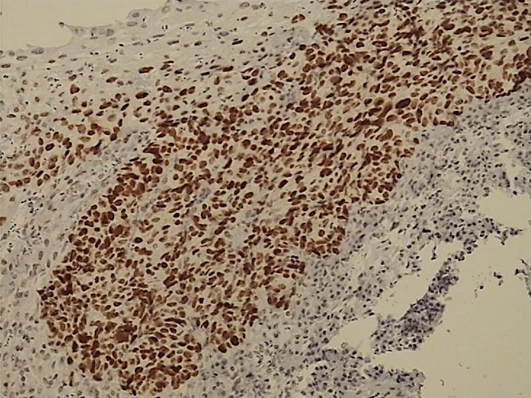 Slika 42. Prikaz imunohistokemijskog bojanja na p53 pločastog karcinoma gradusa II i okolnih pločastih, nemalignih epitelnih stanica u orofarinksu.