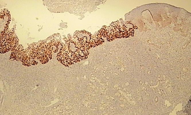 Slika 43. Prikaz imunohistokemijskog bojanja na p53 pločastog karcinoma in situ/teške displazije i okolnog pločastog, nemalignog epitela u orofarinksu.