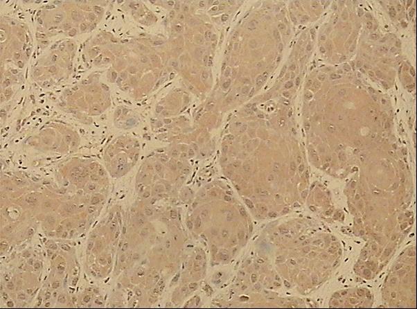 Slika 19. Prikaz imunohistokemijskog bojanja na HNE uzorka pločastog karcinoma gradusa I orofarinksa.