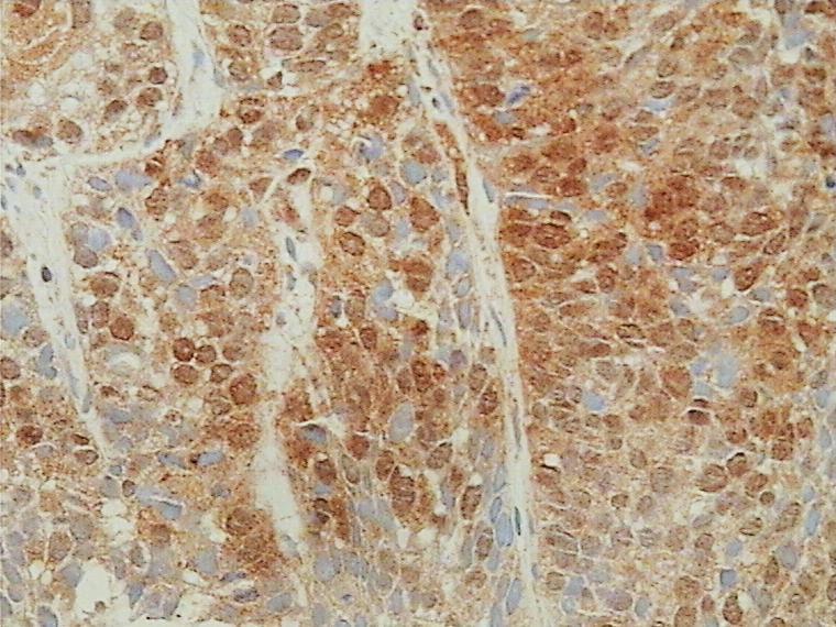 Slika 20. Prikaz imunohistokemijskog bojanja na HNE pločastog karcinoma gradusa III orofarinksa.