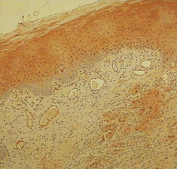 Slika 22. Prikaz imunohistokemijskog bojanja na HNE uzorka pločastog, nemalignog epitela sluznice orofarinksa uz pločasti karcinom.