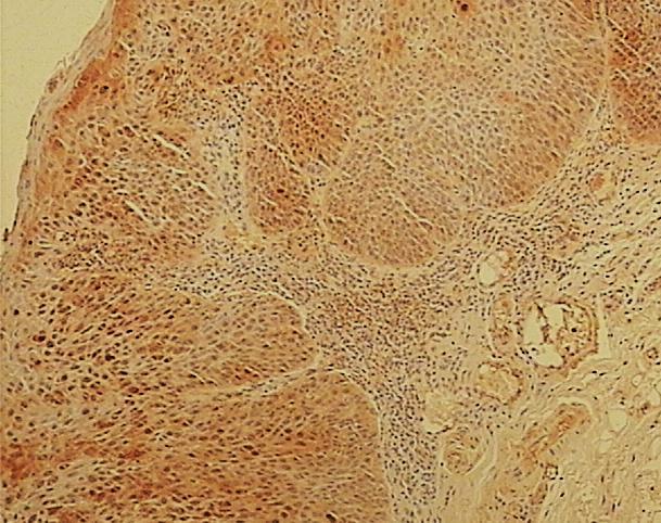 Slika 23. Prikaz imunohistokemijskog bojanja na HNE uzorka teške displazije sluznice orofarinksa.