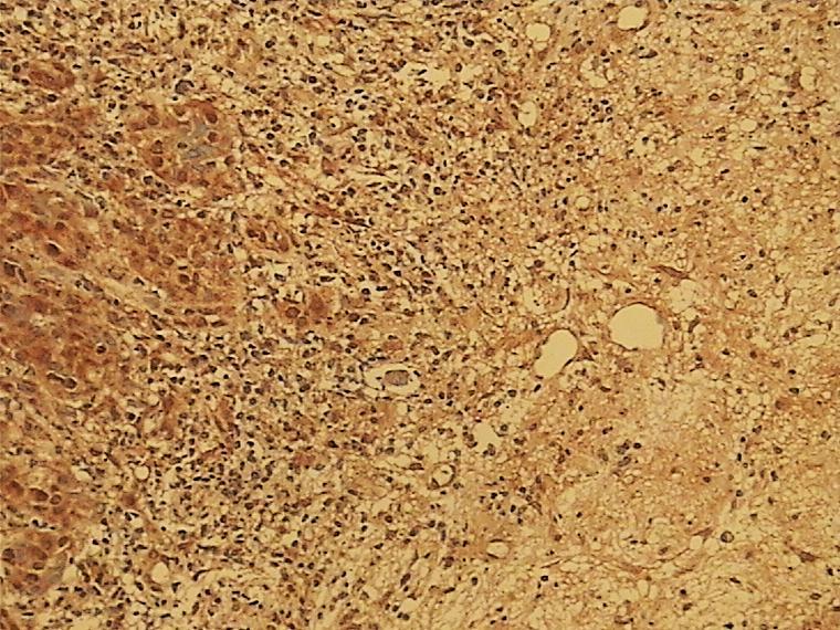 Slika 24. Prikaz imunohistokemijskog bojanja na HNE vezivne strome oko tumora u uzorku pločastog karcinoma orofarinksa.