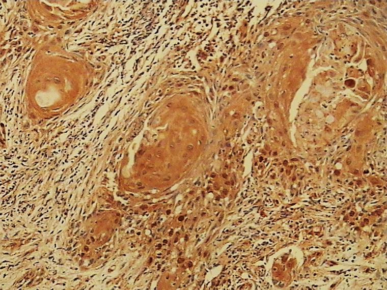Slika 29. Prikaz imunohistokemijskoh bojanja na HNE pločastog karcinoma gradusa II orofarinksa.