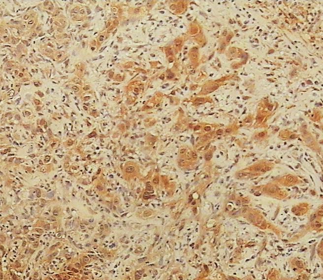 Slika 30. Prikaz imunohistokemijskog bojanja na HNE pločastog karcinoma gradusa III orofarinksa.