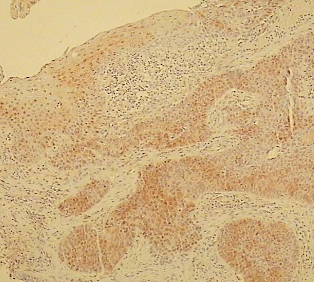 Slika 34. Prikaz imunohistokemijskog bojanja na HNE pločastog, nemalignog epitela uz pločasti karcinom gradusa III orofarinksa.