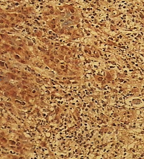 4.4.7. Usporedba nazočnosti HNE-a u upalnim stanicama u tumorskoj stromi po histološkom gradusu tumora Imunopozitivitet HNE-a u upalnim stanicama u tumorskoj stromi prikazan je na slici 35.