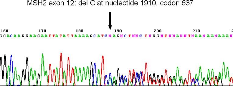 Vol. 50, No. 10 LYNCH SYNDROME IN ARGENTINA 1609 Figure 1. Sequence analysis. Novel mutation (arrow) of individual III:21 in Family C pedigree. new cases are expected each year.