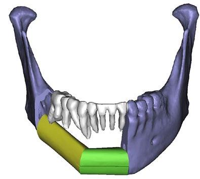 RABIE SHANTI ABOVE: 3D images from virtual surgical planning (VSP) sessions, showing the planning of a mandibular tumor resection while also incorporating fibula free flap reconstruction.