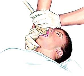 Insertion of the Laryngeal Mask Airway The steps for insertion of the laryngeal mask airway (Figure 5) are as follows: Step Action 1 Patient preparation: Provide oxygenation and ventilation, and