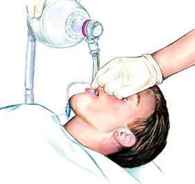 Figure 5. Insertion of the laryngeal mask airway. Cautions/Additional Information Do not apply cricoid pressure because it may hinder the insertion of the laryngeal mask airway.