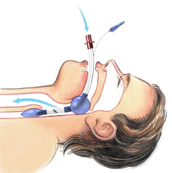 Insertion of the Laryngeal Tube Step Action 1 Patient preparation: Provide oxygenation and ventilation, and position the patient.