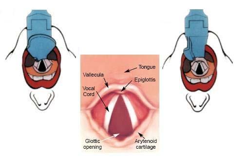 Figure 11. View of the vocal cords. Indications for Endotracheal Intubation Cardiac arrest when bag-mask ventilation is not possible or is ineffective.