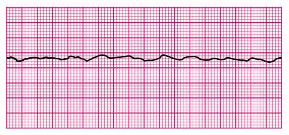 . Figure 17B. Figure 17. A, Coarse ventricular fibrillation. Note high-amplitude waveforms, which vary in size, shape, and rhythm, representing chaotic ventricular electrical activity.