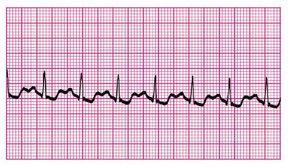 Part 2: Recognition of Selected Nonarrest ECG Rhythms Recognition of Supraventricular Tachyarrhythmias (SVTs) Sinus Tachycardia (Figure 19) None more a physical sign than an arrhythmia or