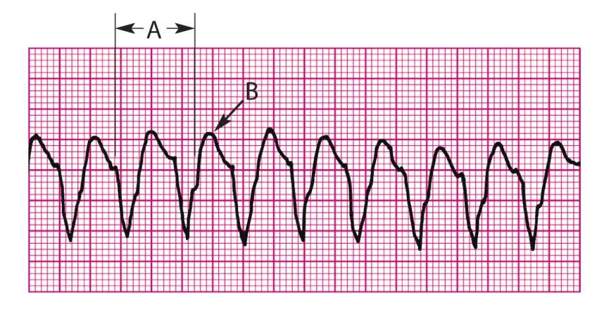 Clinical Manifestations Common Etiologies Typically symptoms of decreased cardiac output (orthostasis, hypotension, syncope, exercise limitations, etc) do develop Monomorphic VT can be asymptomatic