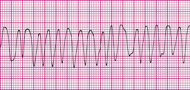Defining Criteria per ECG Key: Marked variation and inconsistency seen in QRS complexes Clinical Manifestations Common Etiologies Rate: ventricular rate >100 beats per minute; typically 120 to 250