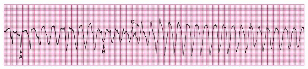 Figure 25. Torsades de pointes: a unique type of polymorphic VT. A, Start of a spindle. Note negative initial deflection and increasing QRS amplitude. B, End of a spindle and start of a node.