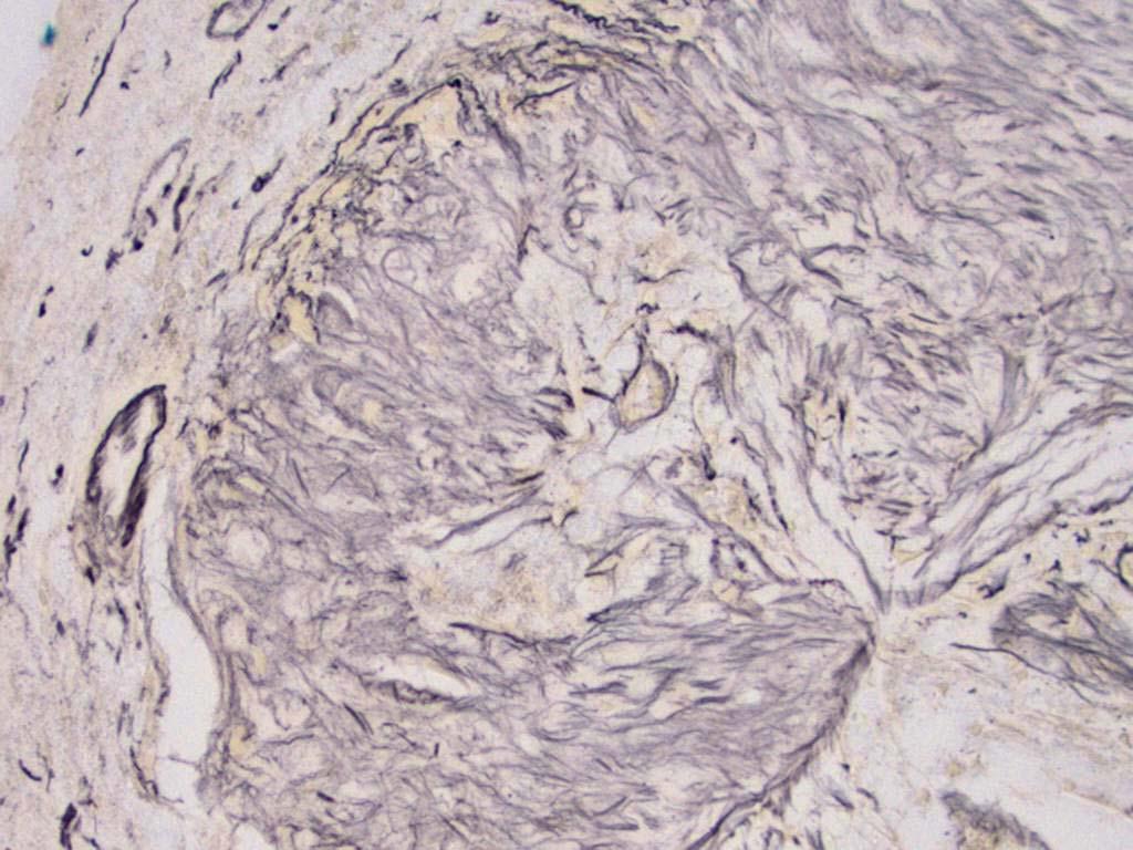 Reticulin stain at interface between