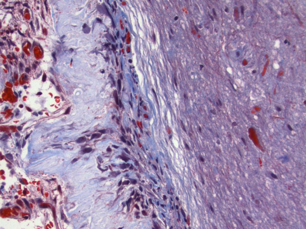 Trichrome stain at interface between lesion (left)