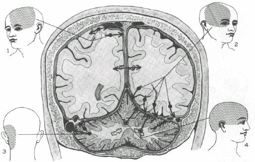 PAIN-PRODUCING INTRACRANIAL STRUCTURES Ray BS, Wolff HG. Arch Surg. 1940.
