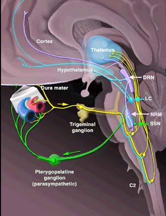 MIGRAINE HEADACHE: HOW IS IT GENERATED? Involves abnormal activation of trigeminocervical afferents OR abnormal modulation of trigeminocervical neurons Weiller C et al. Nat Med. 1995.