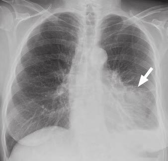 Radiographic Follow-Up of Pneumonia A C B D Fig.
