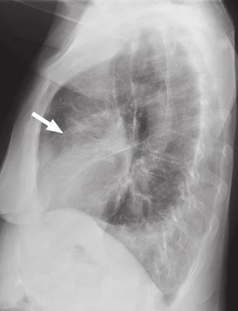 clinical symptoms) show incomplete clearing of lingular opacity (arrows)