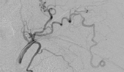 hypoperfusion ischemia (DHHIS or DHIS) Arterial Inflow Stenosis in Dysfunctional AV Access Duijm