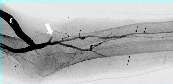 Stenosis in Dysfunctional AV Access DSA confirmed 18 of these lesions in 13 patients Distal