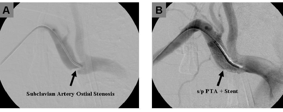 Distal Revascularization and Interval Ligation (DRIL) Over decades experience with excellent patency of AV access and bypass vein Treatment of choice (Surgery) Alternatives of DRIL RUDI, PAI Banding