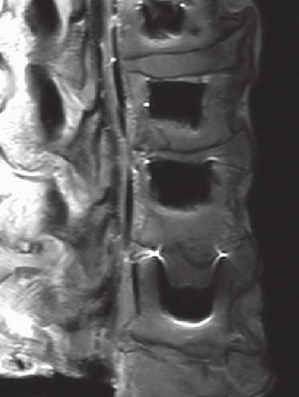 of PEEK interbody implants during imaging