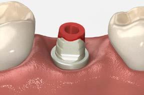 the healing abutment Remove the healing abutment using an.050 (1.25mm) hex driver.