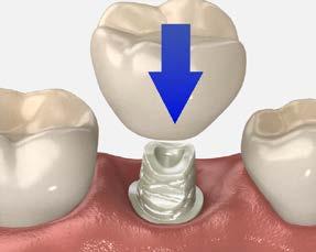 Note: Replace the healing abutment immediately to prevent soft tissue collapse over the implant.