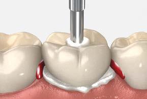 temporary restorations screw-retained crown using a PEEK temporary abutment 8 Fill the shell crown Mix acrylic or another material of choice and place inside the shell crown.