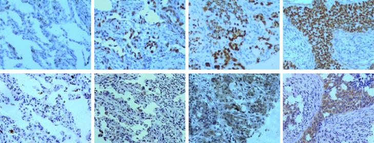 Mutant p53 activates TDP2 expression Figure 7. Immunohistochemical staining of p53 and TDP2 in lung cancer or peri-cancer tissues.
