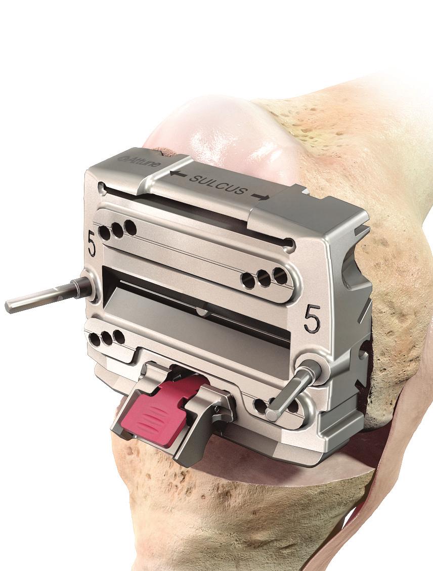 Femoral A/P Position The 4-in-1 Cutting Block