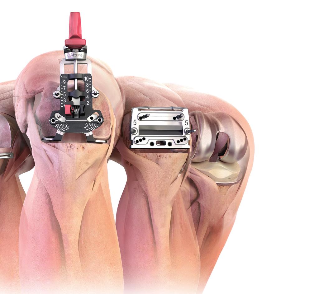 The ATTUNE Knee System implants and INTUITION Instruments were developed together to allow you the flexibility to fine tune the placement of each component.