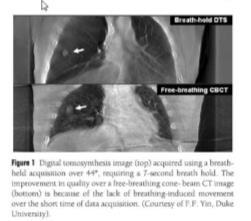Precise and real-time measurement of 3D tumor motion in lung due to breathing and heartbeat measured