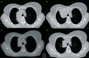 Change in volume and position of adenocarcinoma of right lung during radiotherapy GTV changes from original CT scan (A), to repeat CT scan on day 24 (B), MVCT scan from Tomotherapy on day 60, kvct