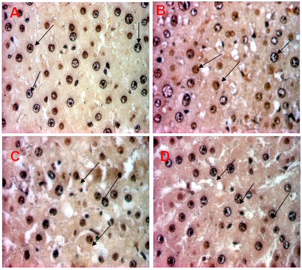 Nisa et al. Figure 6. Hematoxylin and eosin stained of lymphoblastic cells in liver tissues of DMBA control group (20 mg/kgbw in CMC-Na).