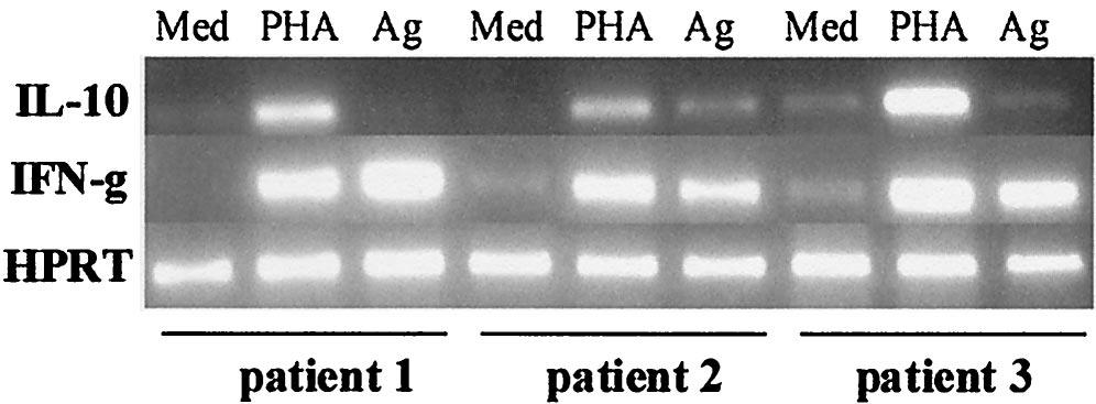 VOL. 70, 2002 IMMUNOREGULATION IN ML 6737 FIG. 2. Cytokine mrna expression in PBMC from three ML patients with different stimuli.
